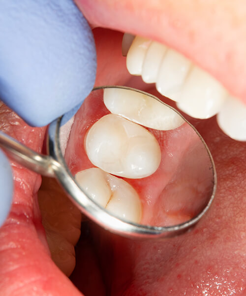 Close up shot of dental sealants