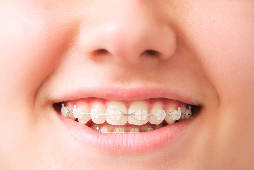 Clear Braces: A Discreet and Effective Solution for Orthodontic Treatment