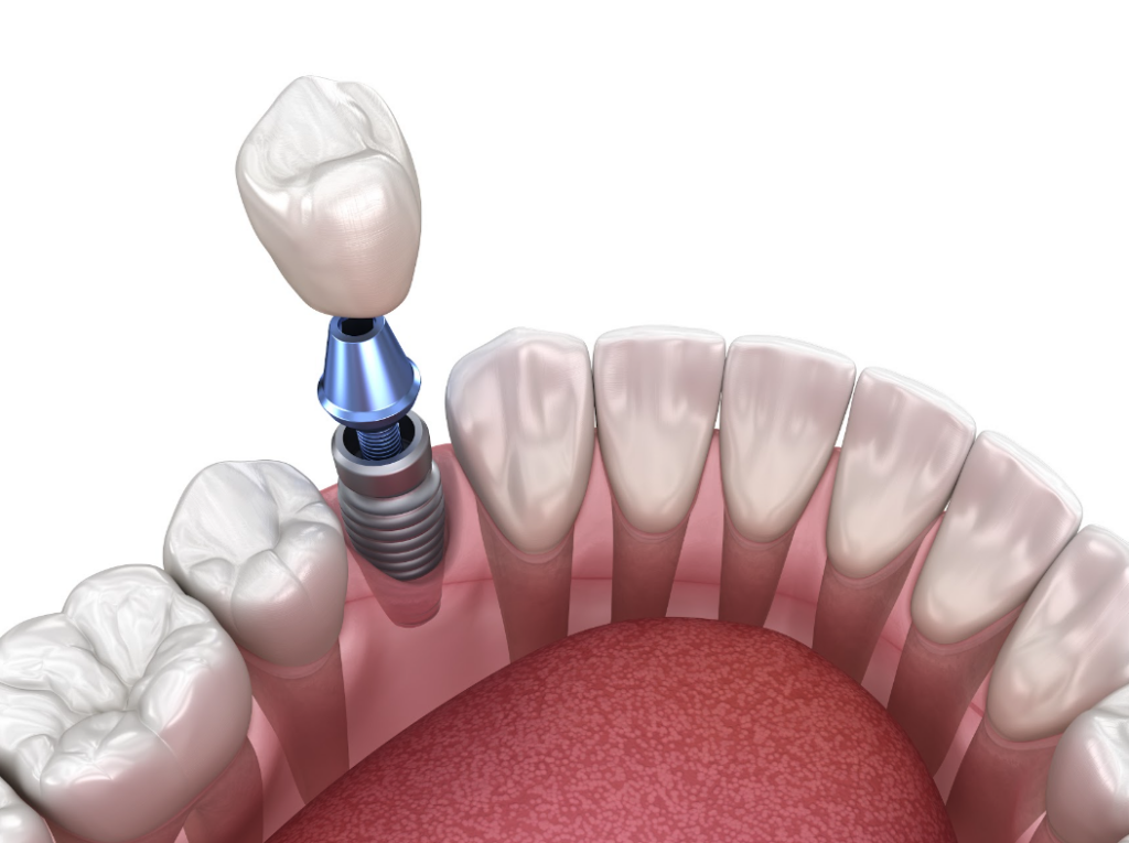 A rendering showing the structure of a dental implant within the gum.