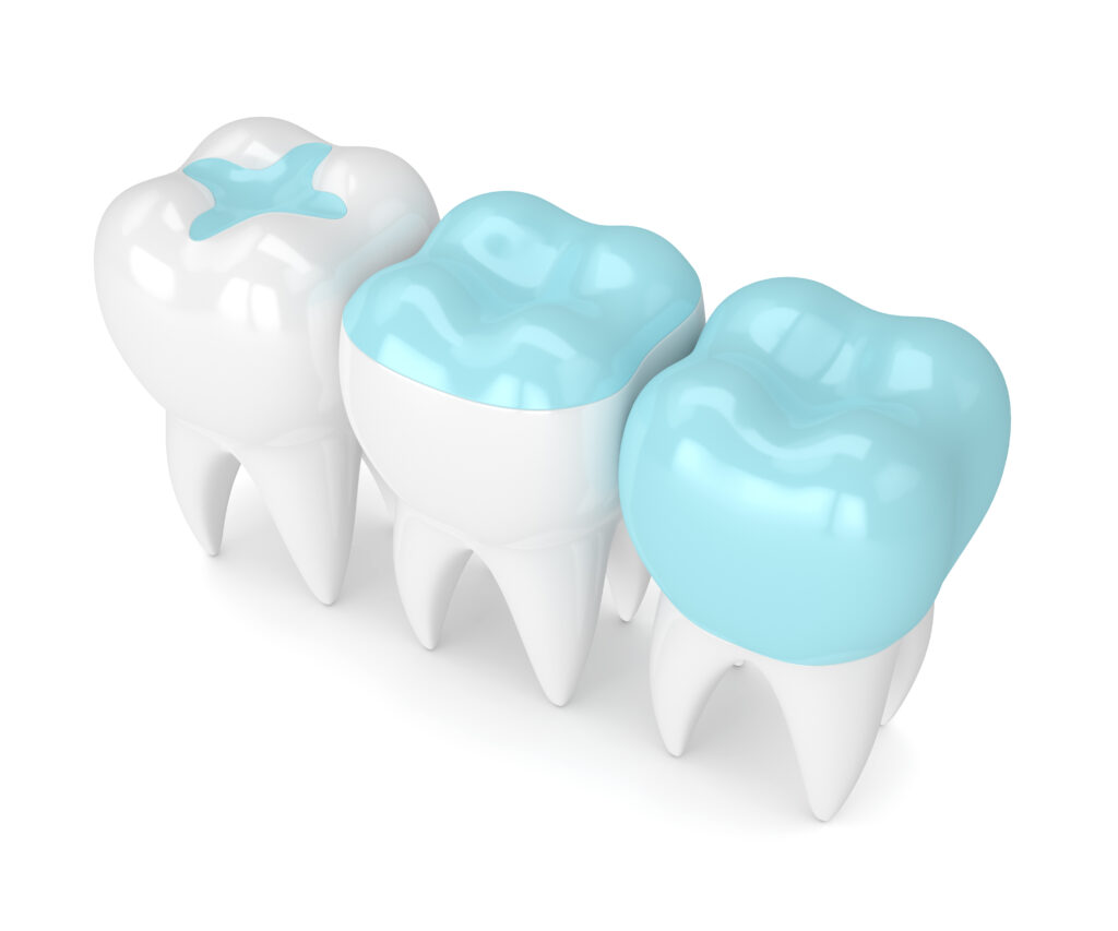Tooth-sealants